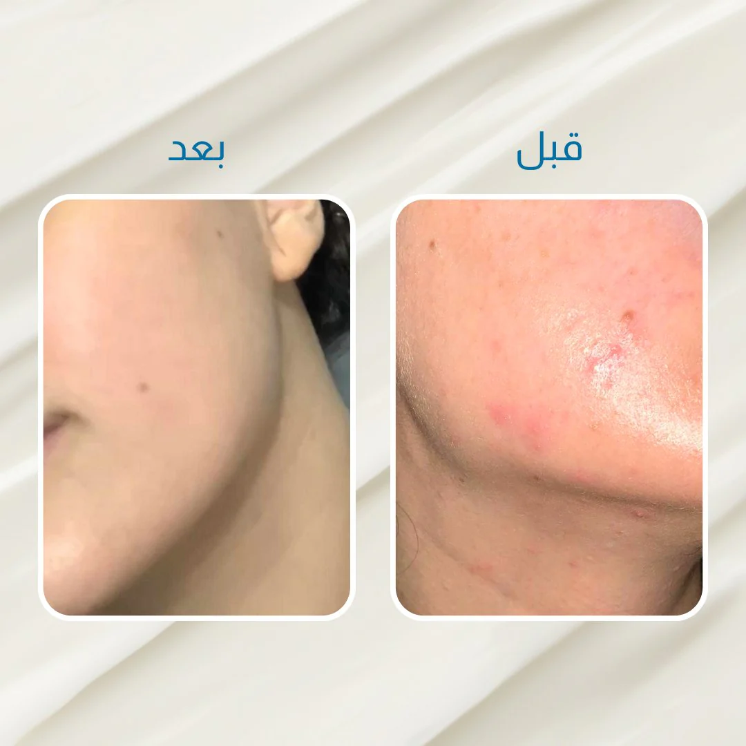 الكورس الاقوى لعلاج الحبوب - Image 4