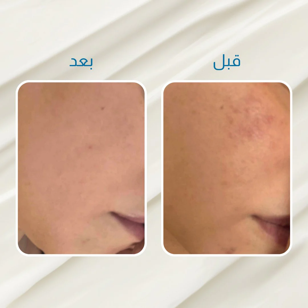 الكورس الاقوى لعلاج الحبوب - Image 5