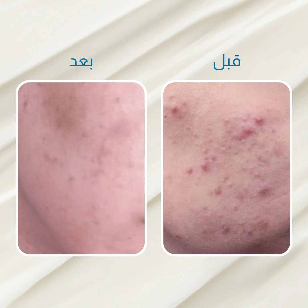 الكورس الاقوى لعلاج الحبوب - Image 6
